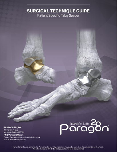 File Download of SURGICAL TECHNIQUE GUIDE Patient Specific Talus Space