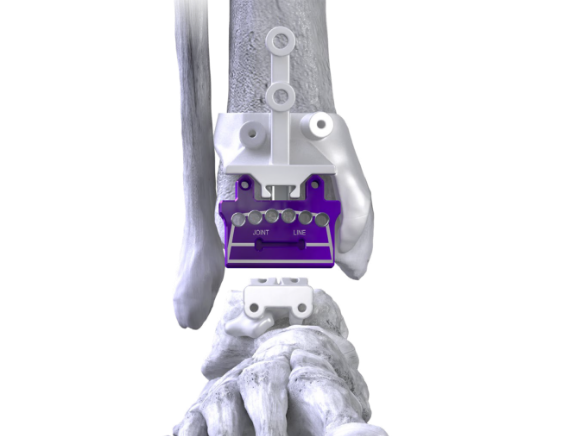 MAVEN™ Patient-Specific Instrumentation (PSI) System